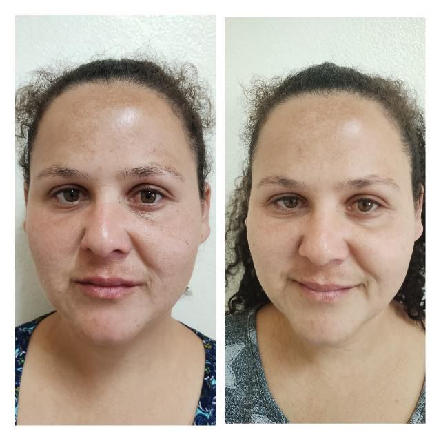 Sérum Facial Rosa Mosqueta Amazônica - Antes e Depois