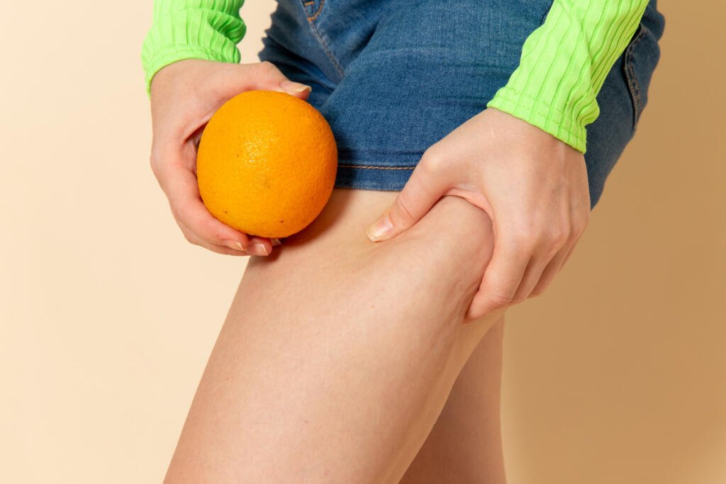 A celulite e o lipedema são condições que afetam a aparência da pele, mas têm causas e tratamentos distintos.